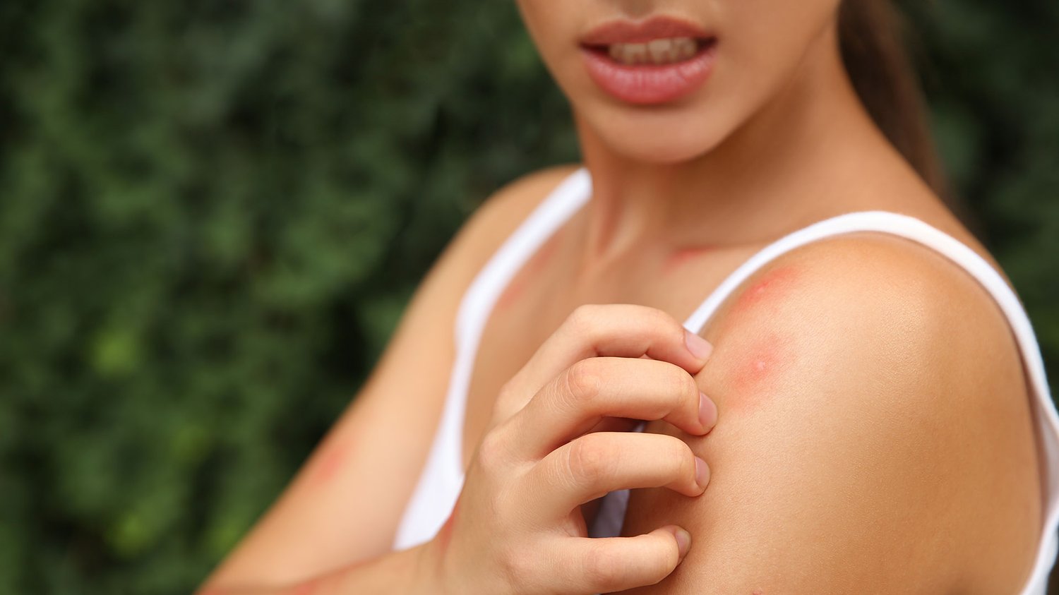 why-do-mosquito-bites-cause-different-reactions